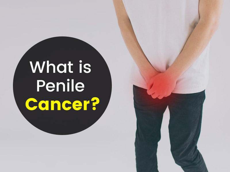 Penile Cancer: Know Symptoms, Risk Factors And Treatment Methods
